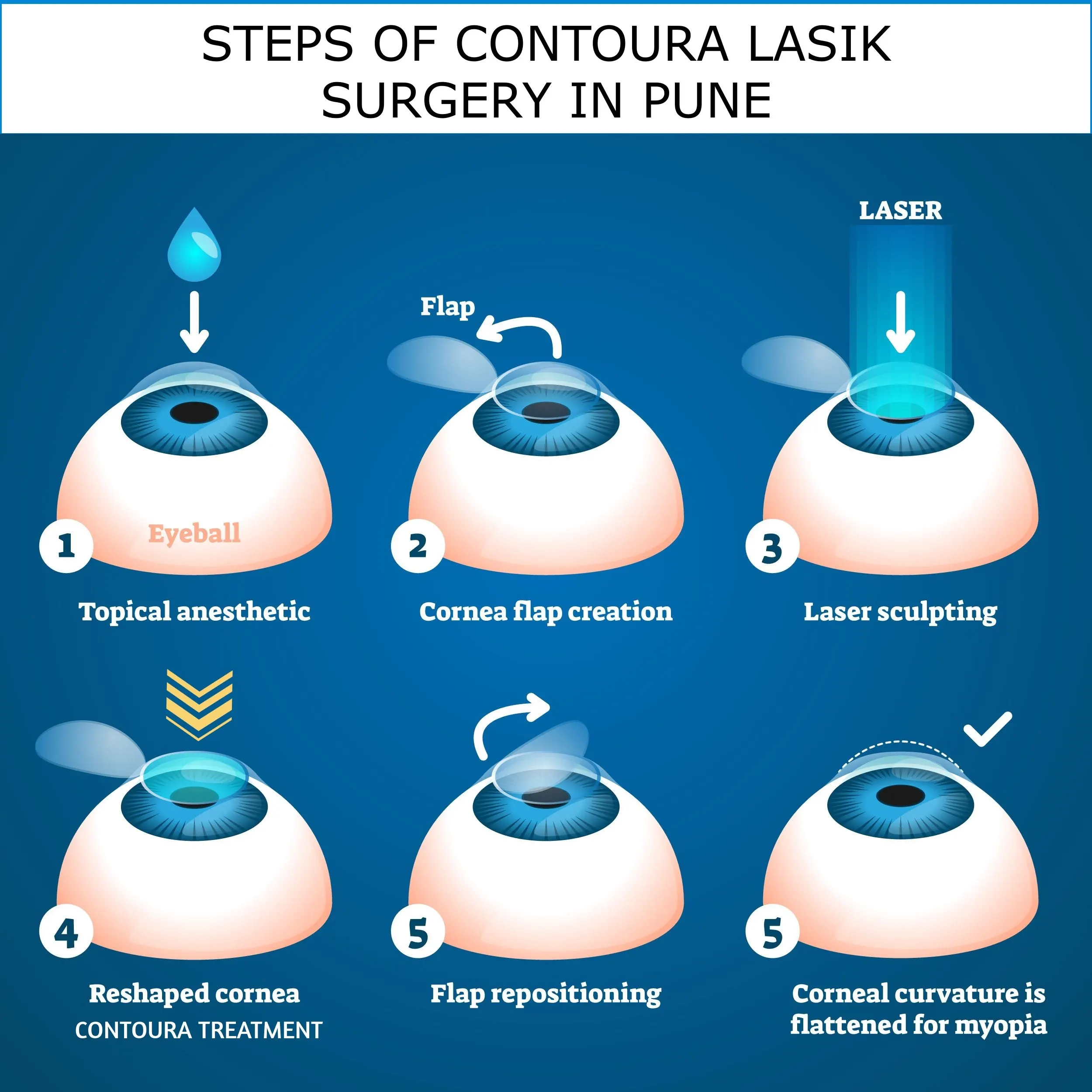 steps of contoura lasik surgery